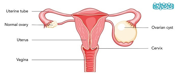 آیا کیست تخمدان مانع بارداری میشود؟